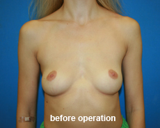 plastic-surgery-breast-augmentation